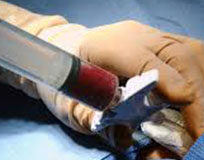 A 70 anni dona il midollo alla sorella