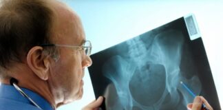 Ospedale di San Donà, eccellenza per la frattura del collo del femore