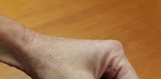 Il braccialetto salvavita presto ai polsi di tremila pazienti con diabete dell’Ulss 3 Il braccialetto salvavita AIDme