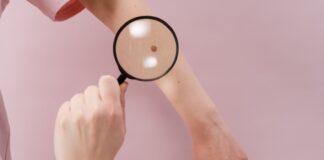 Nei rossi sulla pelle: come riconoscerli