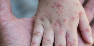 Vaiolo delle scimmie, 400 dosi di vaccino al Veneto