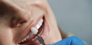 Faccette dentali: cosa sono e costi faccette dentali
