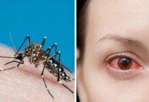 Dengue a San Vendemiano, quarto caso importato: scatta la disinfestazione Febbre elevata Piastrinopenia Larvicidi porta a porta Dolori articolari