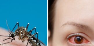 Dengue a San Vendemiano, quarto caso importato: scatta la disinfestazione Febbre elevata Piastrinopenia Larvicidi porta a porta Dolori articolari
